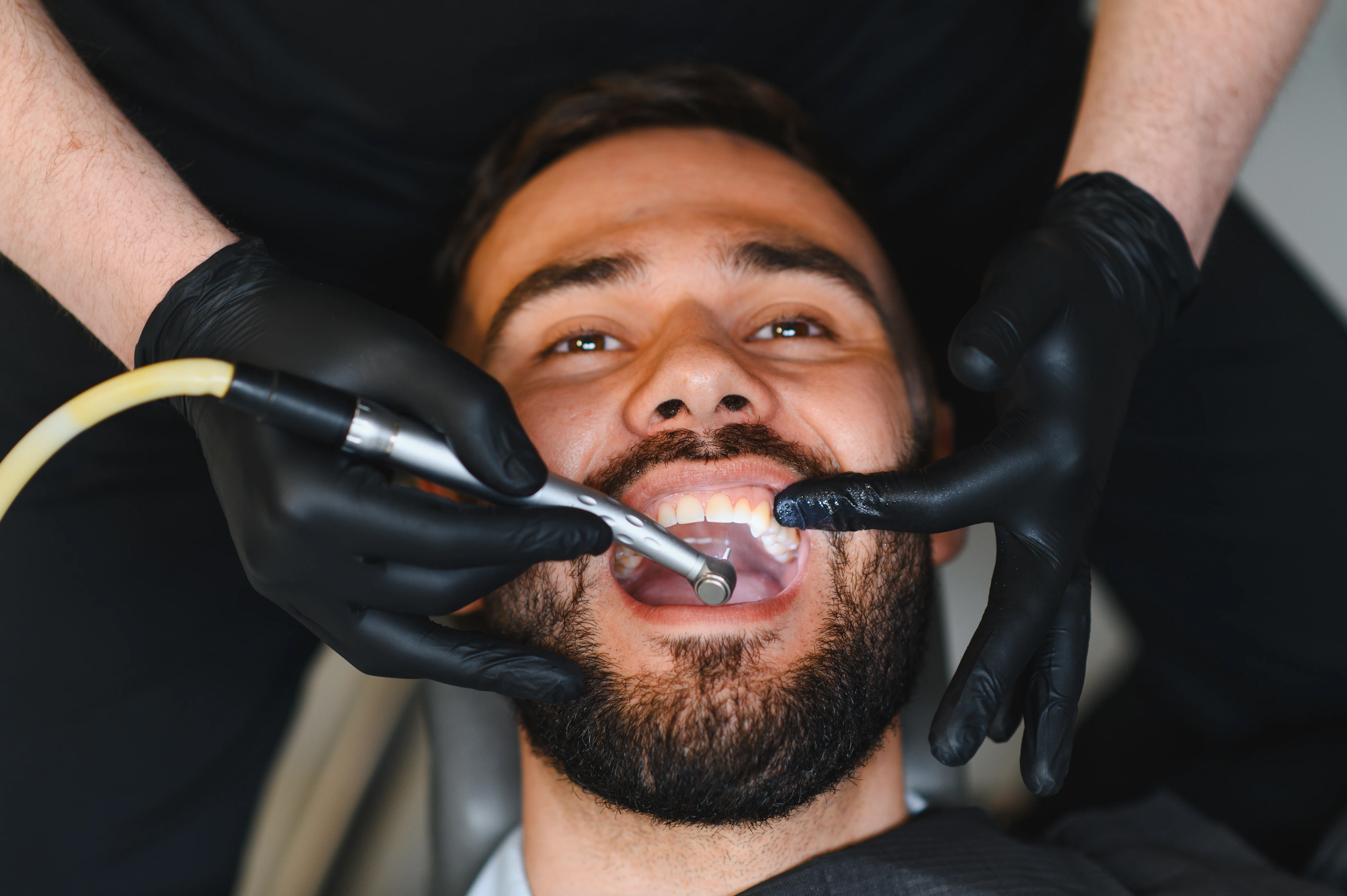 Dental sealants for cavity prevention